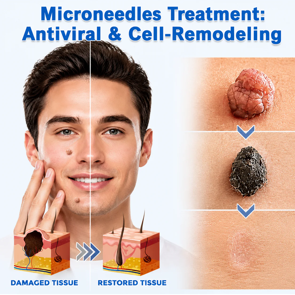 ✨Soraloza® 2-in-1 Microneedle & Hydrocolloid Patch🍀 | Removes raised moles, acne, flat warts, and skin tags | Helps improve wrinkles, scars, and blemishes | Invisible patches for face and body