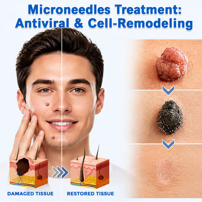 ✨Soraloza® 2-in-1 Microneedle & Hydrocolloid Patch🍀 | Removes raised moles, acne, flat warts, and skin tags | Helps improve wrinkles, scars, and blemishes | Invisible patches for face and body