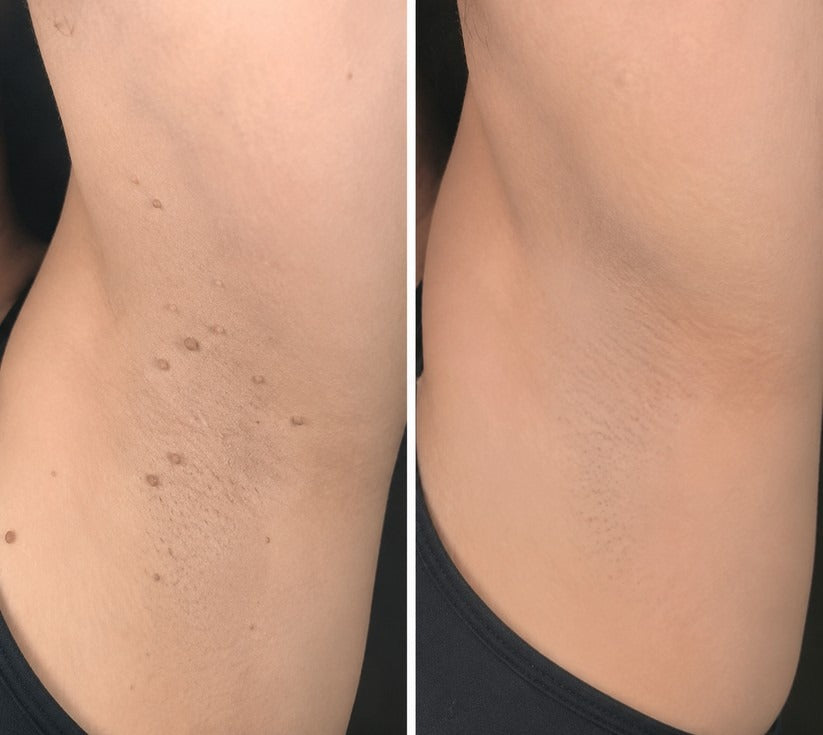 ✨Soraloza® 2-in-1 Microneedle & Hydrocolloid Patch🍀 | Removes raised moles, acne, flat warts, and skin tags | Helps improve wrinkles, scars, and blemishes | Invisible patches for face and body