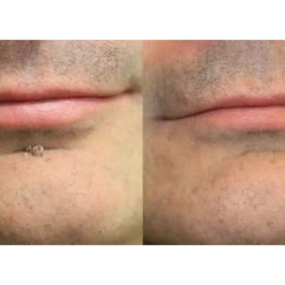✨Soraloza® 2-in-1 Microneedle & Hydrocolloid Patch🍀 | Removes raised moles, acne, flat warts, and skin tags | Helps improve wrinkles, scars, and blemishes | Invisible patches for face and body