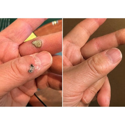 ✨Soraloza® 2-in-1 Microneedle & Hydrocolloid Patch🍀 | Removes raised moles, acne, flat warts, and skin tags | Helps improve wrinkles, scars, and blemishes | Invisible patches for face and body