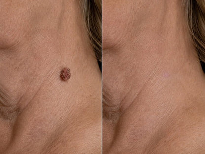 ✨Soraloza® 2-in-1 Microneedle & Hydrocolloid Patch🍀 | Removes raised moles, acne, flat warts, and skin tags | Helps improve wrinkles, scars, and blemishes | Invisible patches for face and body