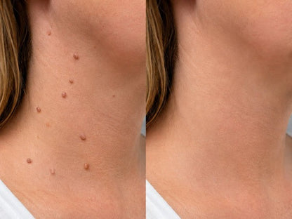 ✨Soraloza® 2-in-1 Microneedle & Hydrocolloid Patch🍀 | Removes raised moles, acne, flat warts, and skin tags | Helps improve wrinkles, scars, and blemishes | Invisible patches for face and body