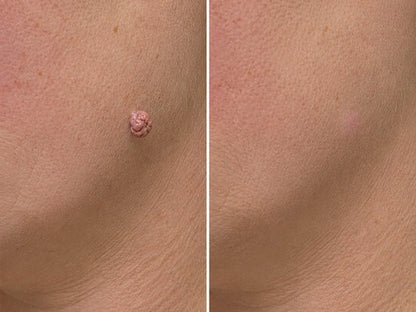 ✨Soraloza® 2-in-1 Microneedle & Hydrocolloid Patch🍀 | Removes raised moles, acne, flat warts, and skin tags | Helps improve wrinkles, scars, and blemishes | Invisible patches for face and body